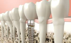 Titanium Dental Technologies showcase 1